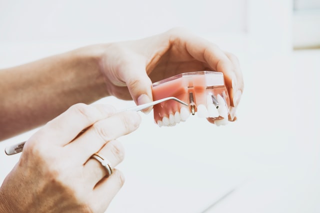Co to jest implant zęba?