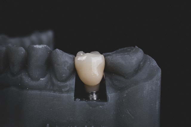 Implanty zębów - ile kosztują?