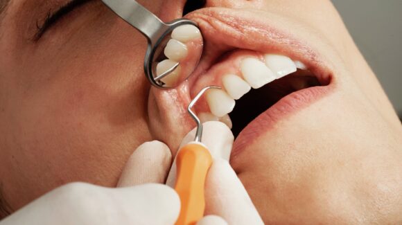Jak się robi implanty zębów?
