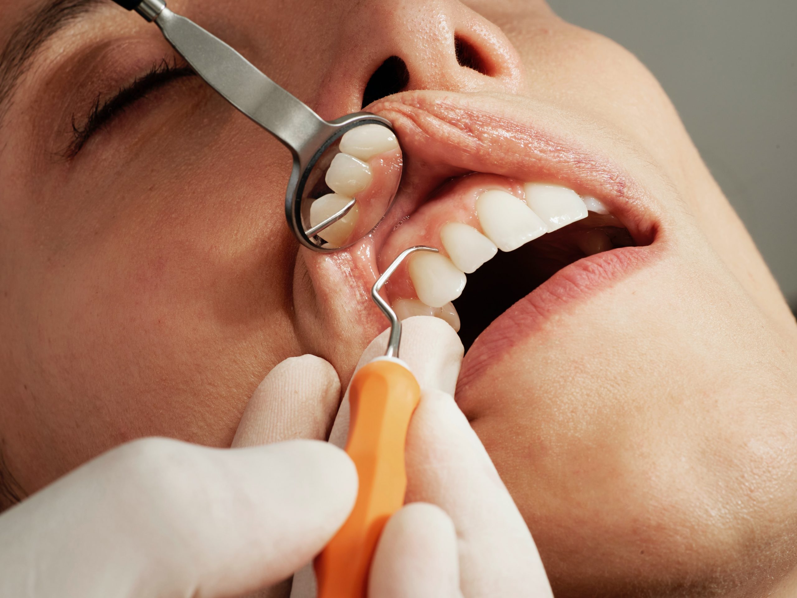 Ile kosztują implanty wszystkich zębów?