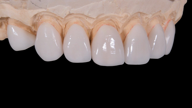 Po wyrwaniu zęba - kiedy implant?