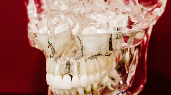 Ile kosztuje złoty implant zęba?