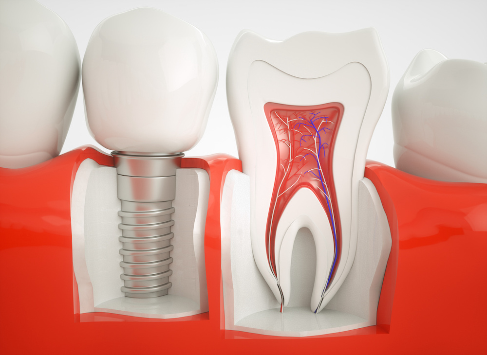 Healthy teeth and an implant