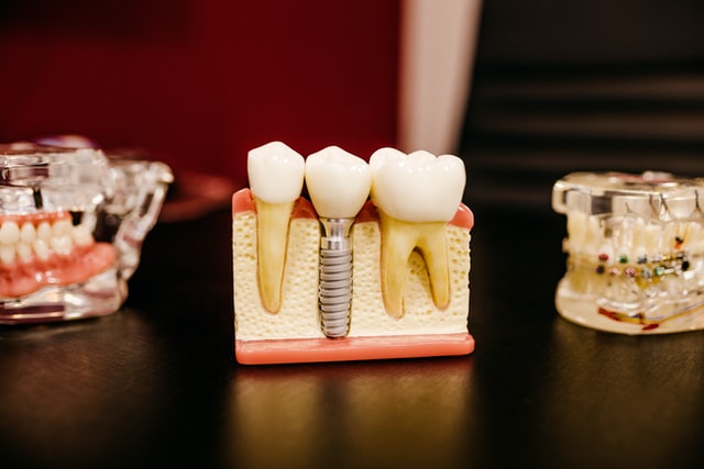 Kiedy można wstawić implant zęba?