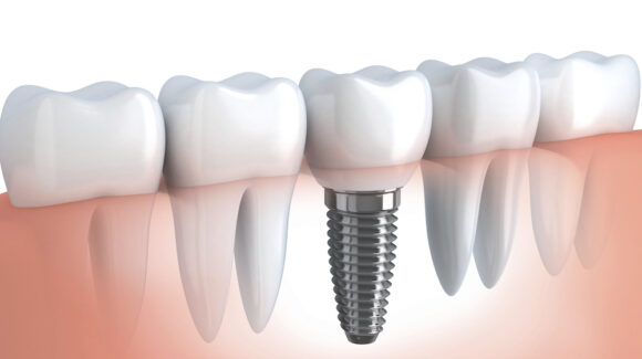 Uczulenie na implanty zębowe objawy