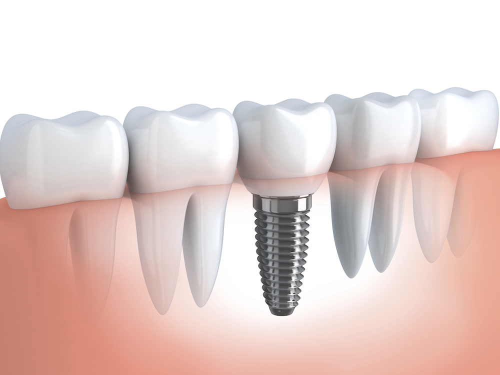 Uczulenie na implanty zębowe objawy