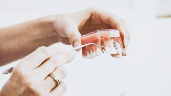 Z czego wykonane są implanty zębowe?