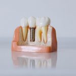Niedoczynność tarczycy a implanty zębów