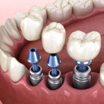Dlaczego warto wybrać implanty zębów